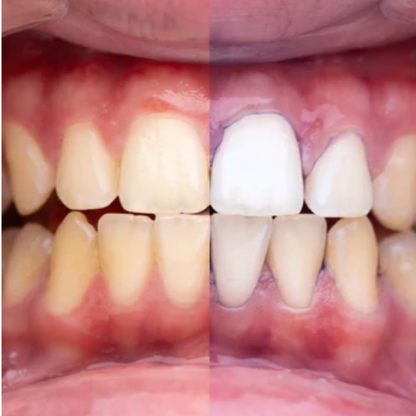 Blanqueador Dental Smilekit V34 - El fin de los dientes amarillos en 1 minuto